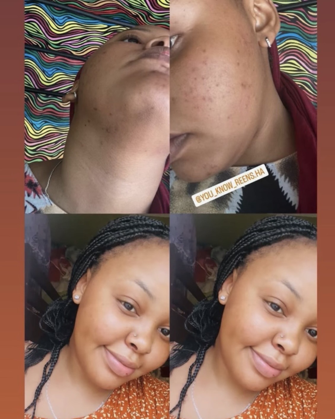 Kidoty Skin Care client skin progress